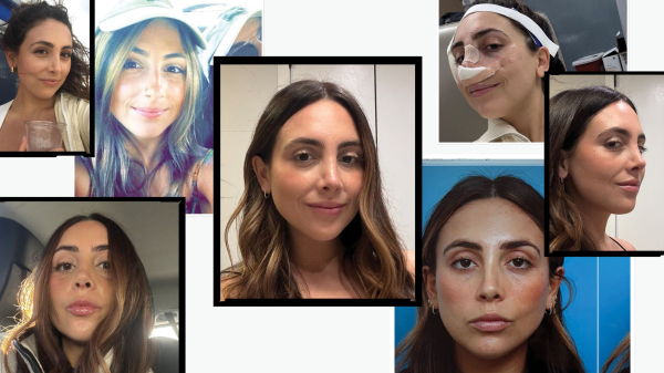 I Got a Revision Rhinoplasty to Fix My Nose Job—Before & After Photos